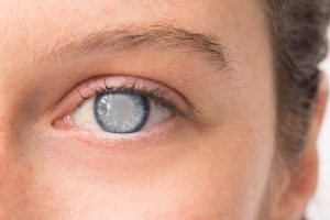 Чому важливо вибрати якісні ліки від катаракти